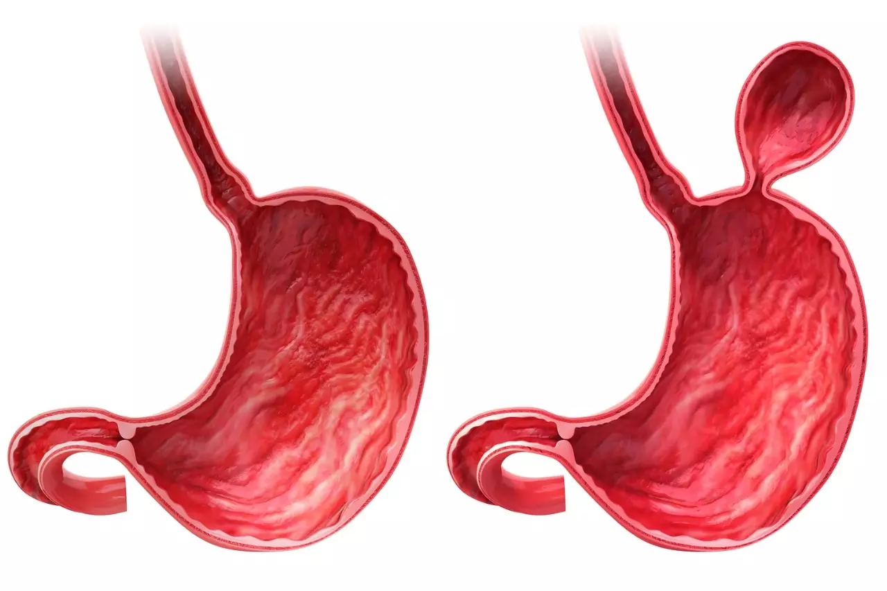 Hernia hiatal
