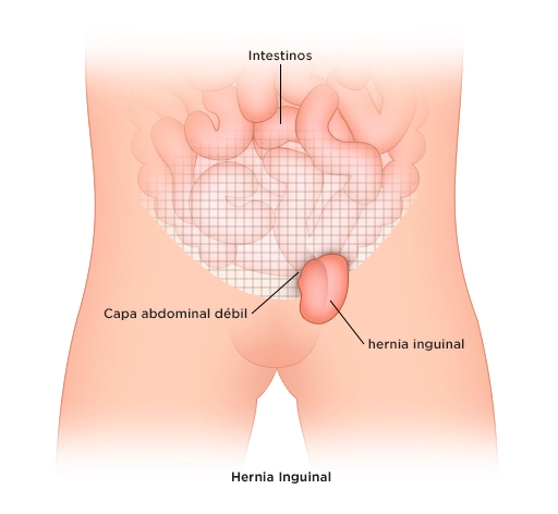Hernia inguinal