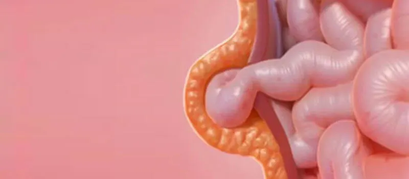 Hernia umbilical